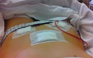 Операции на кишечнике