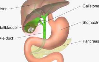 Виды камней в желчном пузыре