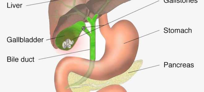 Виды камней в желчном пузыре