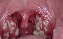 Гной во рту