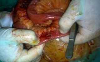 Повреждения тонкого кишечника