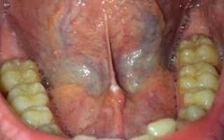 Воспаление уздечки под языком