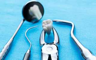 Как выполнить удаление зуба мудрости на верхней челюсти