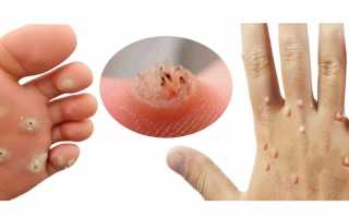 Вирусные бородавки, как правильно и безопасно вылечить их?