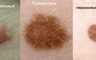 Родинки на лбу, щеках, глазах, на голове в волосах и др.