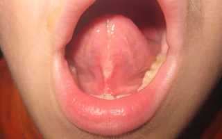 Подрезание уздечки под языком у детей