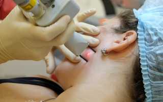 Удаление бородавок — какой способ выбрать и насколько это опасно?