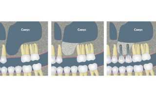 Что такое синус-лифтинг