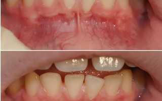 Уздечка нижней губы: пластика у взрослых и детей