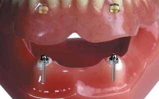 Зубные импланты: фото до и после