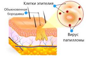 Юношеские бородавки — причины появления у детей, чем лечить?