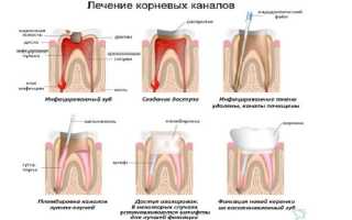 Как чистят каналы зуба: особенности лечения