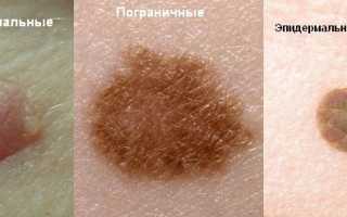 Типы родинок в том числе по онкогенности