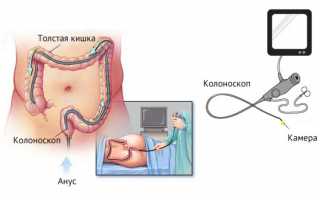 Ультразвуковое исследование прямой кишки