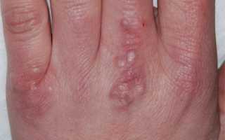 3 причины бородавок в районе рук и как их убрать?