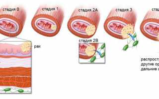 Народные средства при раке пищевода