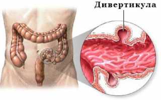 Дивертикулит сигмовидной кишки