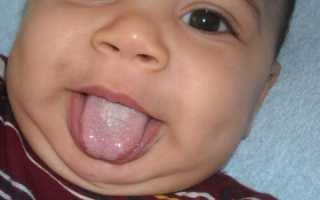 Как лечить кандидоз у ребенка