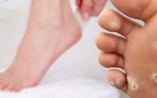 4 причины бородавок на ногах — средства и мази для лечения