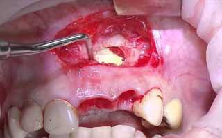 Киста зубов верхней и нижней челюсти