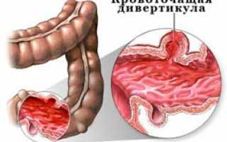 Симптомы и лечение дивертикулеза толстой кишки