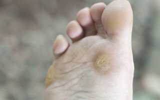 Как вылечить мозоль куриную жолку и не допустить осложнений