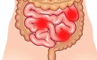 Опухоли тонкого кишечника