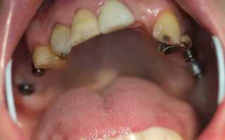 Какие существуют виды имплантатов Nobel Biocare и в чем их преимущества