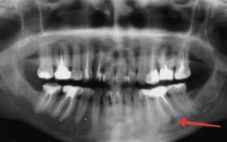 Как выглядит киста десны зуба: симптомы заболевания и фото