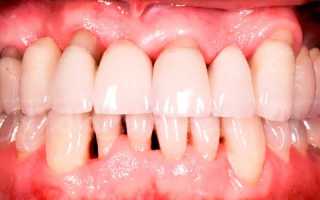 Как выглядит пародонтоз: фото заболевания