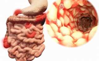 Дивертикулез кишечника