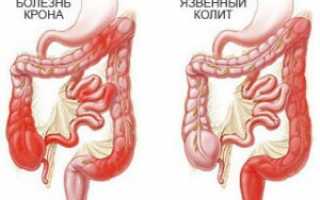 Кишечные заболевания