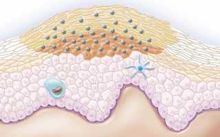 Причины плоских кондилом на интимных местах и не только