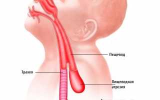 Пищеводно-трахеальные свищи
