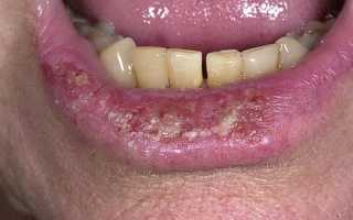 Как выглядит рак губы: симптомы и первые признаки