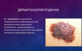Дерматоскопия родинок — 5 преимуществ, где обследоваться?