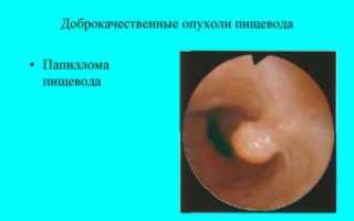 Симптомы и лечение плоскоклеточной папилломы пищевода