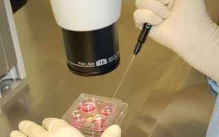 Поликистоз это показание для ЭКО?