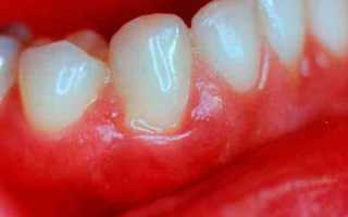 Заболевания десен у взрослых: как распознать и вылечить