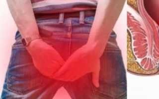 Выпадение прямой кишки (ректальный пролапс)