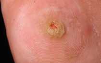 Что делать при воспалении и наличии гноя в мозоли на ноге