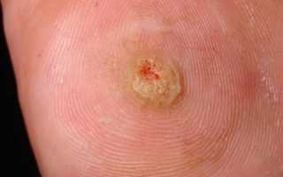 Что делать при воспалении и наличии гноя в мозоли на ноге