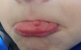 Киста на губе: симптомы и лечение