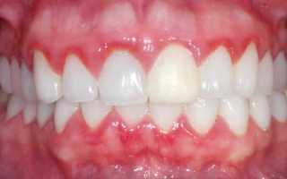 Гингивит у детей: симптомы и лечение