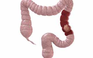 Аденокарцинома кишечника