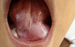 Киста под языком