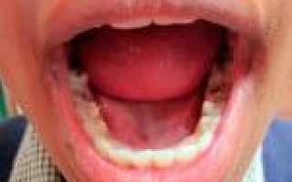 Неприятный запах изо рта: причины и лечение