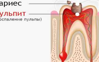 Что делать если в зубе дырка