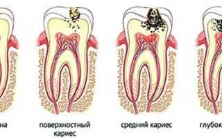 Как выглядит кариес на зубах: фото болезни
