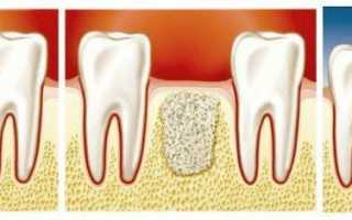 Что такое костная пластика